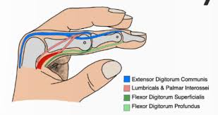 Image result for Lateral PIP Dislocation