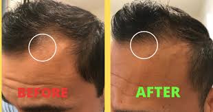 Doctors also frequently prescribe radioactive iodine treatment to their patients with hyperactive some patients experience this years after rai, and some have the loss of salivary gland function for additional problems which presented following rai were hair loss (which is now starting to grow. How To Control Hair Loss And Simultaneously Increase Hair Growth Quora