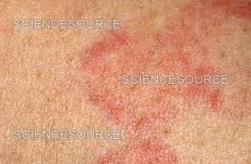 Image result for Urticaria pigmentosa children