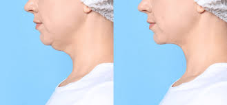 Your cost not only includes the price of the product, but more importantly, the skill and expertise of the healthcare professional who is how many people have been treated with kybella®? Kybella Cost 2021 Prices List For Double Chin Reviews