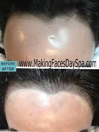 Pin On Microblading Hairline And Bald Spot Restoration