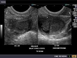 An imaging test of the ovaries, such as a transvaginal ultrasound exam, may be done. A Gallery Of High Resolution Ultrasound Color Doppler 3d Images Ovaries