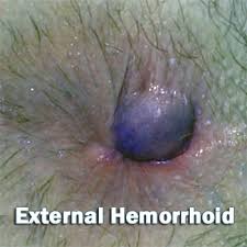 External thrombosed hemorrhoids can be seen and/or felt. Treatment Hemorrhoids Miami