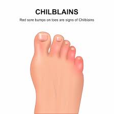 Image result for Chilblains