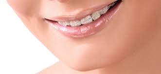 Before considering insurance and other factors, here's what braces cost: Invisible Braces How They Work What They Cost