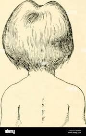 Image result for Cephalhematoma