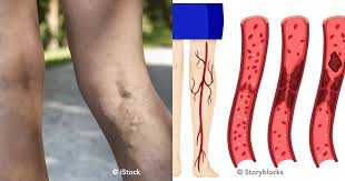 Pueden ser trombos arteriales o venosos. Te Diremos Que Es Una Trombosis Y Como Puedes Prevenirla Va A Gustarme