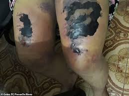 بالصور رجل يحول جسد زوجته إلى لحم فاسد بالتعذيب