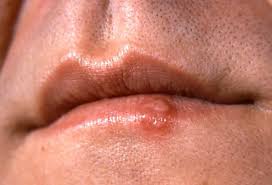 Does anyone get sensations of cold patches on their arms or legs or other parts of the body hello shona, thanks for the advices when i think about it, the cold sensations did appear when i felt hi, i also have these cold spots as well as twitching under my skin. Picture Of Cold Sores Fever Blisters