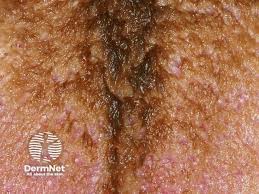 Image result for black hairy tongue symptoms