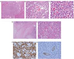 Et hemangiom, på fagspråk kalles det infantilt hemangiom, kalles også et fødselsmerke. Infantile Hemangioma Of The Liver In An Adult A Case Report And Review Of The Literature