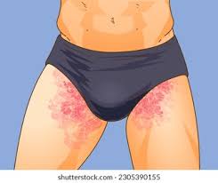 Image result for sore skin in the groin area