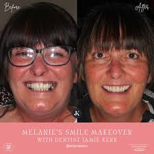 Melanie's Smile Makeover