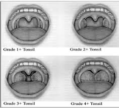 Tonsil Size Chart Related Keywords Suggestions Tonsil