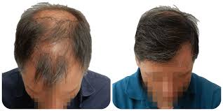 Allowing you to judge the results of your transplant in full. Fue Hair Transplantation Information Prohair Clinic