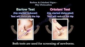 Maybe you would like to learn more about one of these? Barlow And Ortolani Tests Physiopedia