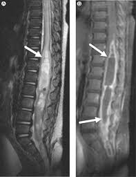 It starts at the foramen magnum as the. Cord Cystic Cavities Syringomyelia And Prominent Central Canal Sciencedirect