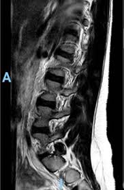 Dorsomediale, rechtsbetonte bandscheibenvorwölbung l5/s1, der duralsack wird hier diskret abgeflacht sowie der eintritt in das rechte neuroforamen mäßig eingeengt. Mrt Bilder Lws Erste Einschatzung