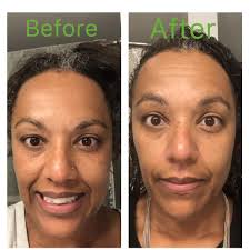 Mug shot alert! Go ahead & Zoom in! This has been about 3 weeks using this  Arbonne's Counter Spot Essence about 2-3x/wk. I can really see the  difference! My sun spots are
