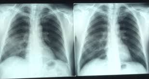 Fibroza pulmonară poate fi secundară unei game largi de afecțiuni sau poate fi idiopatică, fără nici o cauză de bază cunoscută. Video Ce Sechele LasÄ Covid 19 Èi Cum AjutÄ Reabilitarea Respiratorie Ro Health Review