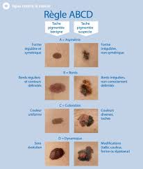 Si vous avez également des points noirs sous la peau, vous avez besoin de nos conseils de soins de l'épiderme. Les Taches Suspectes D Un Cancer De La Peau En Photos