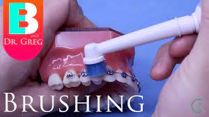 How to brush your teeth with braces youtube. Brushing Your Teeth With Braces Youtube