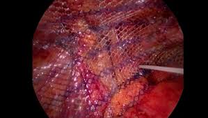 Une hernie inguinale, est une protrusion pathologique d'une portion de péritoine contenant éventuellement des viscères abdominaux, (il s'agit le plus souvent d'une partie de l'intestin grêle, parfois du gros intestin et, dans certains cas, de la vessie,,) par le canal inguinal. Hernia InghinalÄƒ Cat De PericuloasÄƒ Poate Fi Cand Trebuie OperatÄƒ Urgent