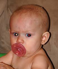 In 2009, my husband and i received the worst news that parents could possibly hear: Photored Know The Glow And Check For Normal Red Eye Reflex In Children We C Hope