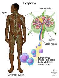 Lymphoma: Symptoms, Causes and Treatment