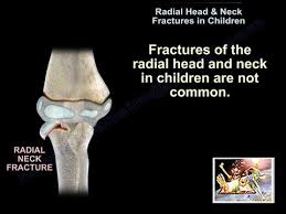 Image result for Fractures in Children