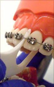 Pin By Loudoun Orthodontics On Dental Braces In Bangalore Dental Braces Braces Tips Teeth Braces