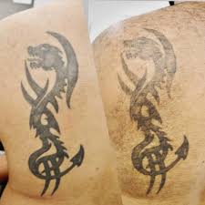 What you should and shouldn't do with a fresh tattoo. What Are The Laser Tattoo Removal Healing Stages Chronic Ink