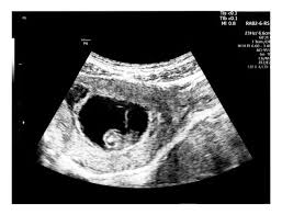 Was sind die ersten schwangerschaftsanzeichen? Ultraschall In Der Schwangerschaft Ab Wann Ist Die Erste Untersuchung Familie De