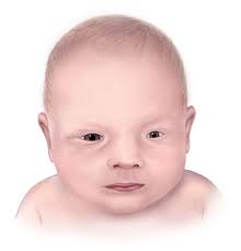 Facts About Anophthalmia Microphthalmia Cdc
