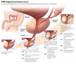 Image result for Prostate Cancer Staging