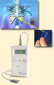 Diaphragm Pacing System A Closer Look Madonna Blog
