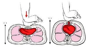 Cardiac arrest prompts defibrillator for beauty spot. What Is Cpr Basic Life Support How Is It Applied