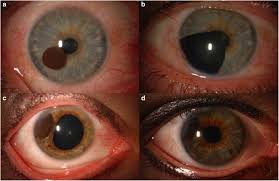 Image result for melanosis sclera