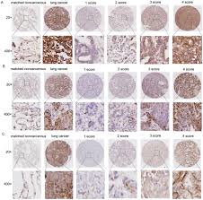 For other types of cancer, too few studies have been done to be able to draw any firm conclusions. Osteopontin Lamb3 And Itgb1 Expression In Lung Cancer Was Associated With Advanced Clinical Stage Histological Grade And Lymph Node Metastasis