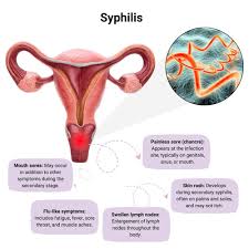 Image result for syphilis symptoms