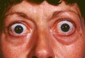 Graves Disease Hyperthyroidism Studying This Common Eye Diseases Thyroid Disease Hyperthyroidism