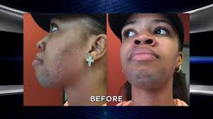 Hirsutism can be seen as coarse, dark hair that may appear on the face, chest, abdomen, back, upper arms, or upper legs. Woman Plagued By Excessive Facial Hair Returns With An Amazing Transformation Youtube