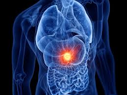 Translucent torso illustration highlighting the upper abdomen at the pancreas region for pancreatic disorder assessment