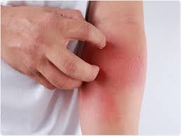 Boosting Immune Cells To Treat Eczema There are way more types of eczema out there than you might realize. boosting immune cells to treat eczema