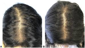 Spironolactone and hair loss in women. Combination Oral Minoxidil And Spironolactone For The Treatment Of Androgenetic Alopecia In Adolescent Girls Journal Of The American Academy Of Dermatology