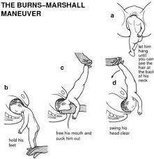 Image result for Breech Delivery