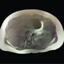 PDF) A Case of Painful Growing Abdominal Wall Mass during Pregnancy  Requiring Resection in the Second Trimester