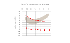 How to read an audiogram for hearing loss. What Is An Audiogram And How To Read It Cochlear
