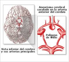 O aneurisma cerebral é o resultado direto de um processo de vaso dilatação que não deveria quando descoberto a tempo, o aneurisma cerebral pode ser tratado antes de causar qualquer tipo. Aneurismas Cerebrales Geni Grupo Espanol De Neurorradiologia Intervencionista