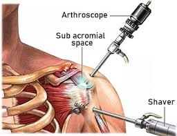 Image result for Subacromial Space Injection